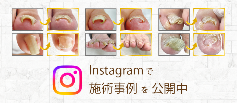 寝屋川巻き爪センターのInstagram